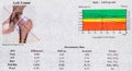 DEXA densitometry report of left femoral scan; diagram and curve of values Ã¢â¬â¹Ã¢â¬â¹used to investigate osteoporosis in menopausal